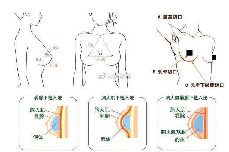 最新隆胸方法探索，现代丰胸技术的新领域