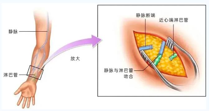 淋巴水肿最新疗法，探索与突破的成果分享