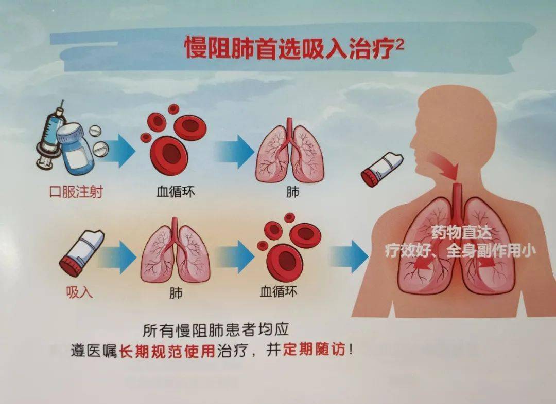 逆转慢阻肺最新技术，重塑呼吸健康新希望