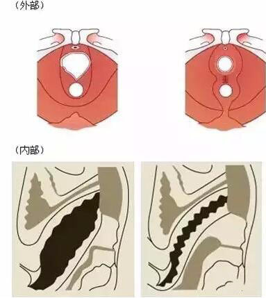 最新缩阴手术，女性盆底健康的关注焦点探讨